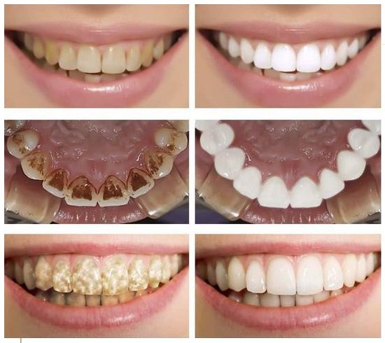 Teeth Plaque Remover Whitening Essence