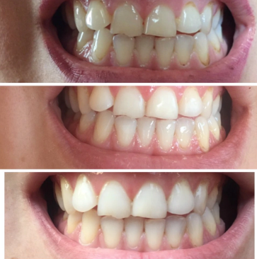 Teeth Plaque Remover Whitening Essence