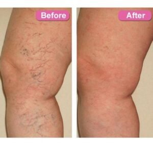 Varicose vein treatment spray for improving circulation and reducing leg vein appearance
