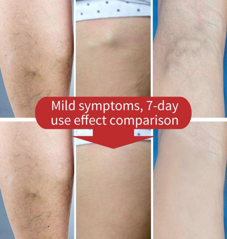 Varicose Vein Treatment Spray